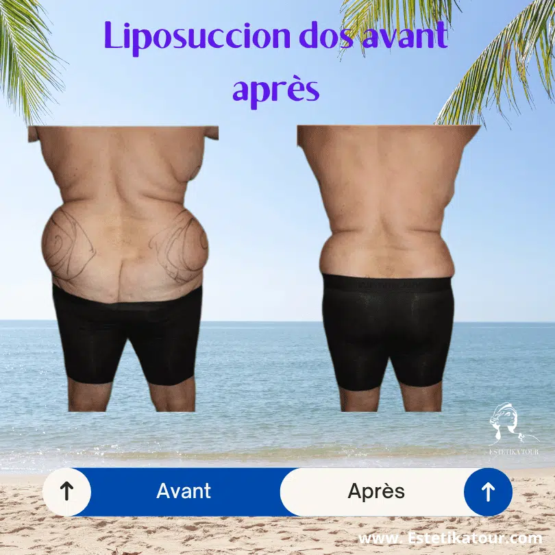 Liposuccion dos avant après