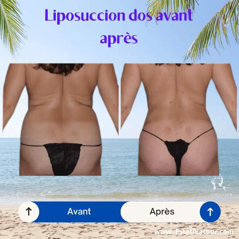 Liposuccion dos avant après