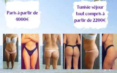 Tarif pour une liposuccion