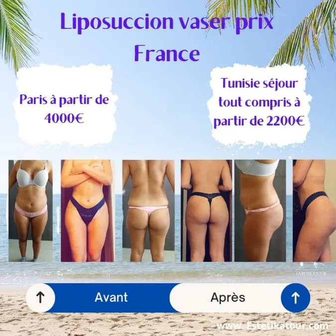 Liposuccion vaser prix france