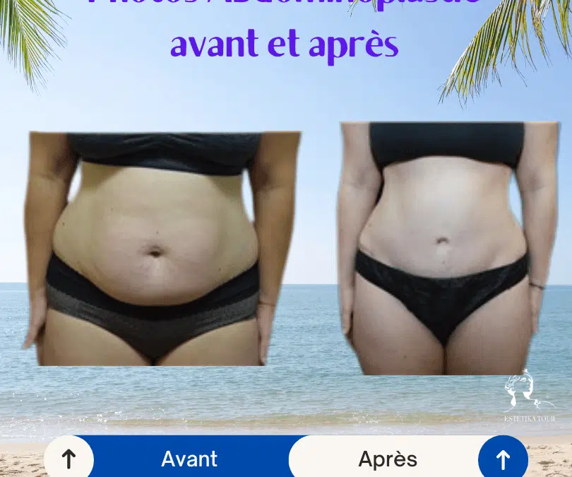 abdominoplastie avant et après