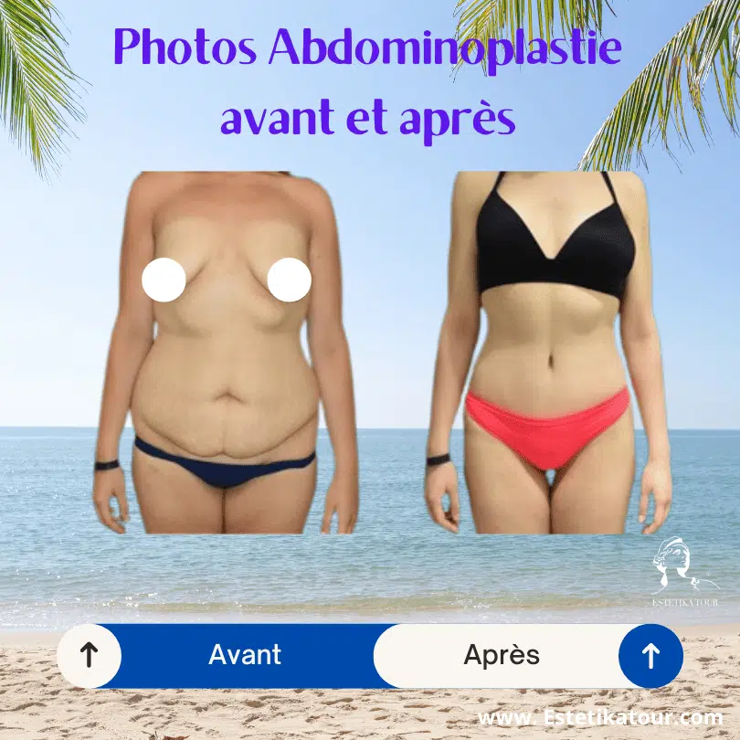 abdominoplastie avant et après