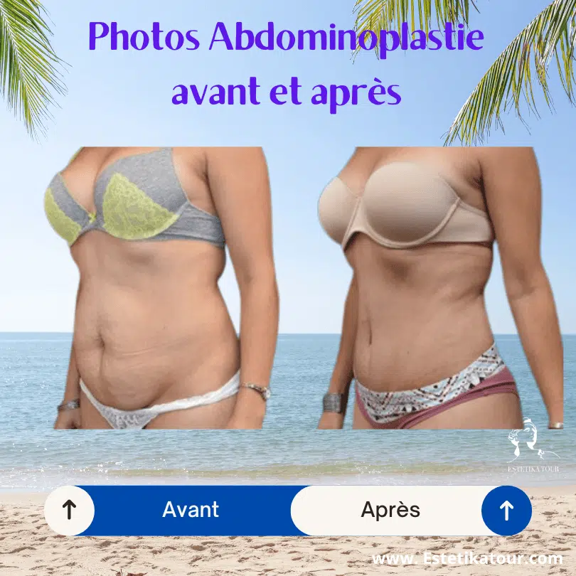 abdominoplastie avant et après