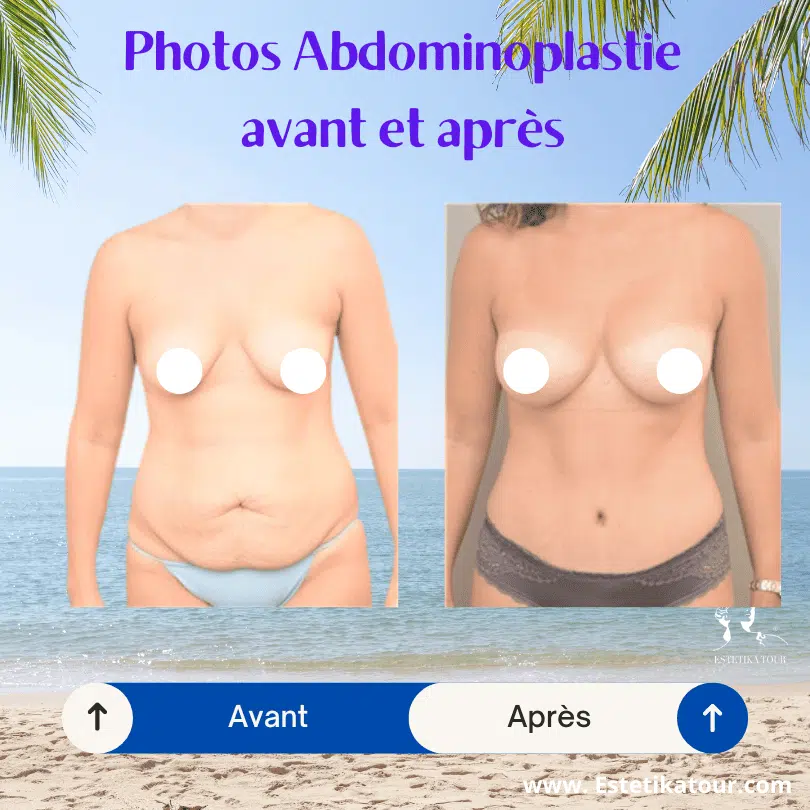 abdominoplastie avant et après