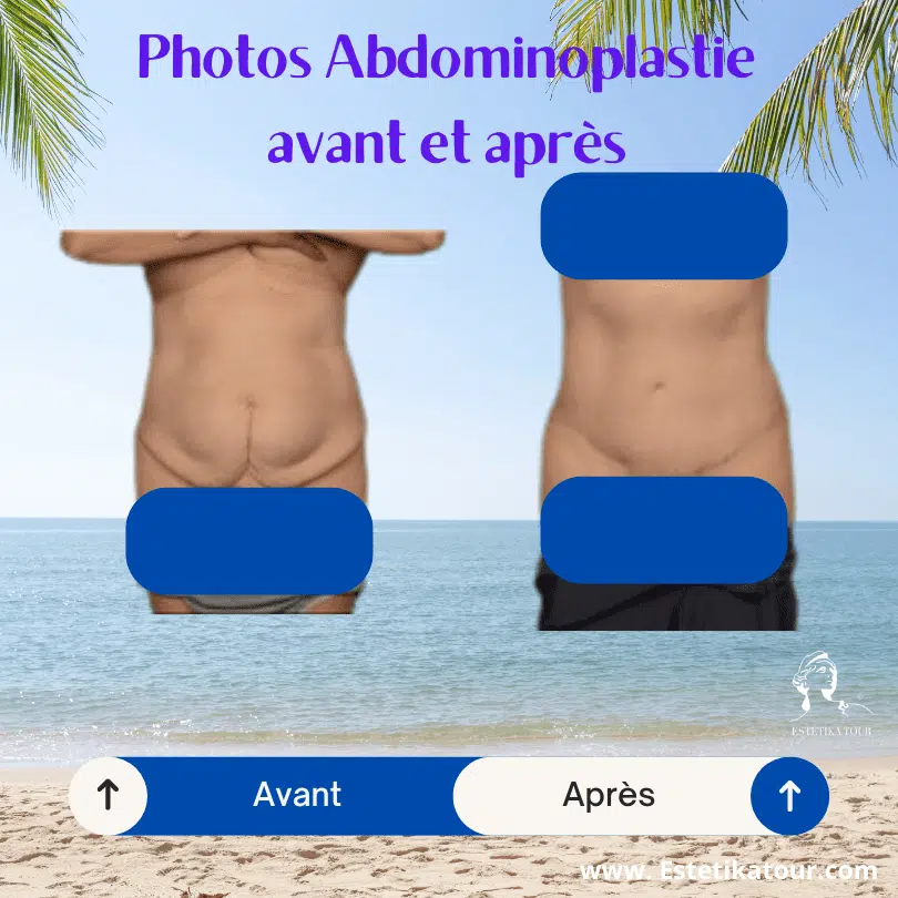 abdominoplastie avant et après