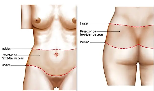 bodylift avant après