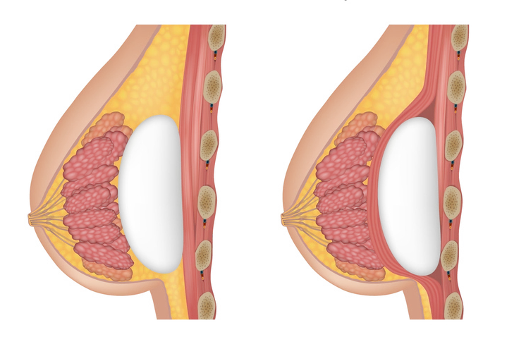 Augmentation mammaire sur le muscle avis