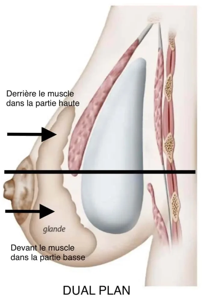 dual plan augmentation mammaire