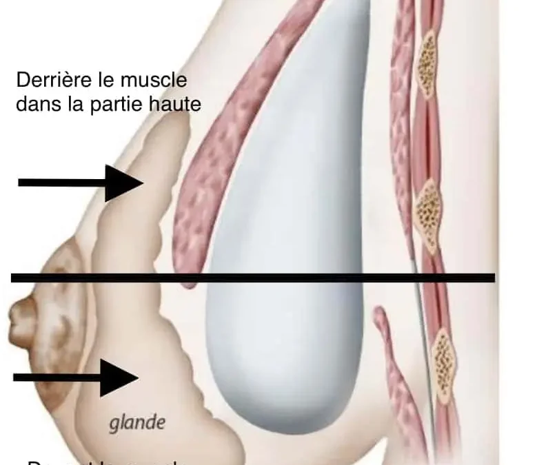 Dual plan augmentation mammaire