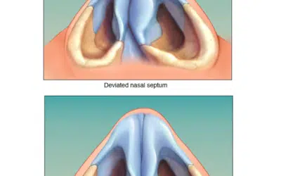 Deviation Nasale : Devis gratuit en ligne