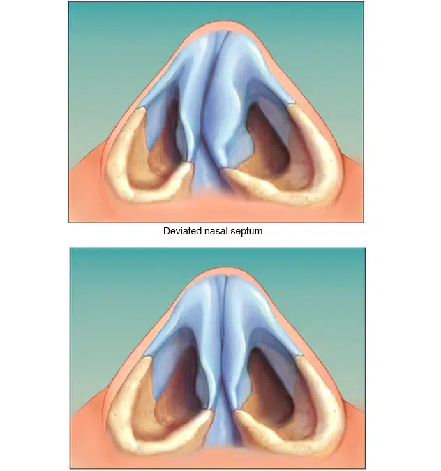 deviation nasale